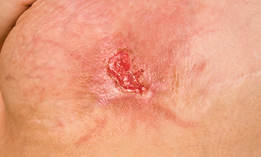 Methicillin Resistant Staphylococcus Aureus