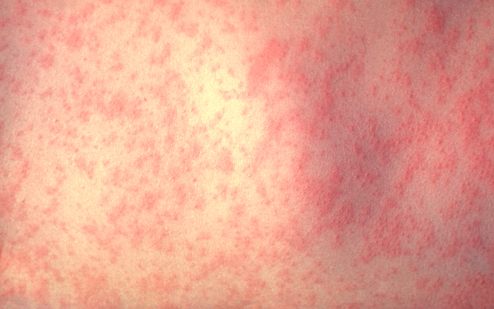 Close up of a person's skin with measles.